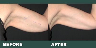 Before and After - Body Contouring - 2